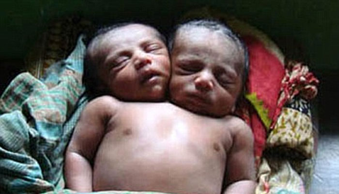 একটি শিশু কিন্তু মাথা দুটো! এমনই একটি 'বিস্ময়কর' শিশু জন্ম নিল বাংলাদেশে