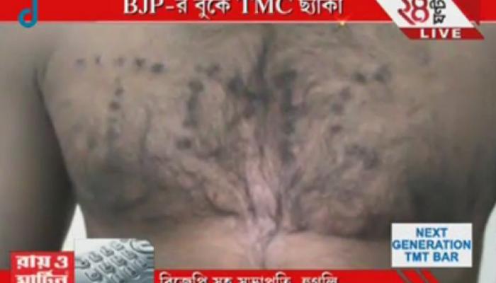 EXCLUSIVE: BJP কর্মীর বুকে সিগারেটের ছ্যাঁকা দিয়ে লেখা হল TMC EXCLUSIVE: BJP কর্মীর বুকে সিগারেটের ছ্যাঁকা দিয়ে লেখা হল TMC