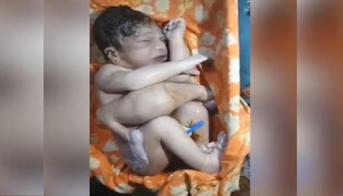 ৪টে পা, ২টি যৌনাঙ্গ নিয়ে রাজস্থানে জন্ম এক 'অদ্ভুতদর্শন' শিশুর (Video) ৪টে পা, ২টি যৌনাঙ্গ নিয়ে রাজস্থানে জন্ম এক 'অদ্ভুতদর্শন' শিশুর (Video)