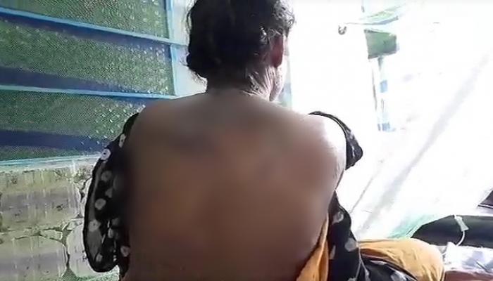 বিয়ের প্রস্তাবে 'না', ঘুমন্ত শ্যালিকার শরীরে অ্যাসিড ঢাললেন জামাইবাবু বিয়ের প্রস্তাবে 'না', ঘুমন্ত শ্যালিকার শরীরে অ্যাসিড ঢাললেন জামাইবাবু